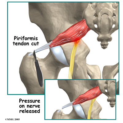 cut in buttocks near sacrum cut in buttocks near sacrum