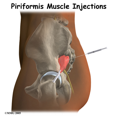 Piriformis Muscle Injections