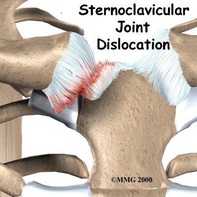 Sternoclavicular Joint Problems