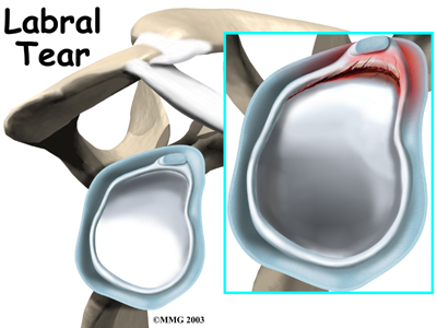 Labral Tears