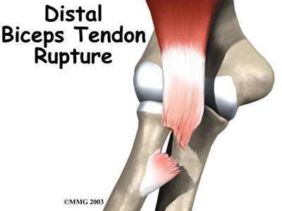 Distal Biceps Rupture