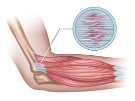 Managing Tennis Elbow