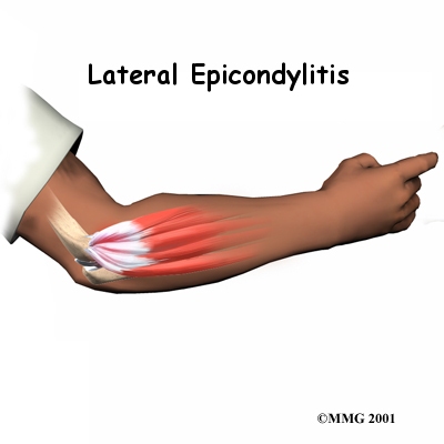 Tennis Elbow (Lateral Epicondylitis)