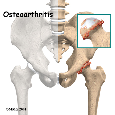 Osteoarthritis of the Hip