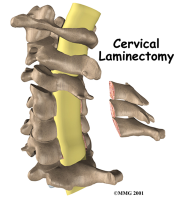 Cervical Laminectomy