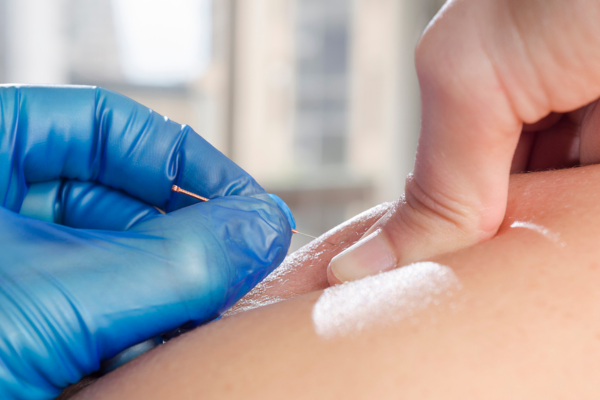 Dry Needling for Shoulder Pain