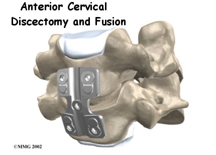 Anterior Cervical Discectomy and Fusion