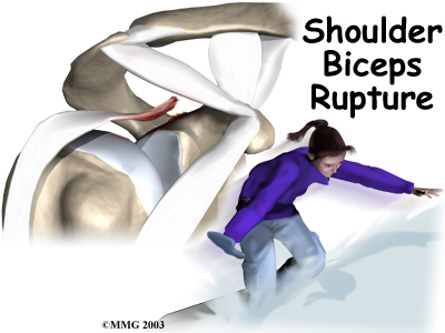 Biceps Rupture