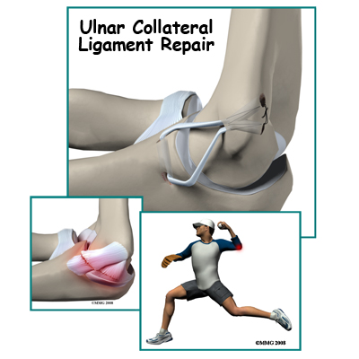 Ulnar Collateral Ligament Reconstruction (Tommy John Surgery)