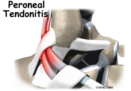 Peroneal Tendon Problems