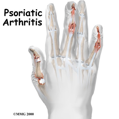 Psoriatic Arthritis