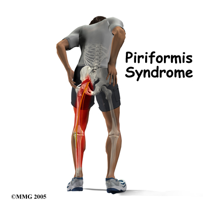 Piriformis Syndrome