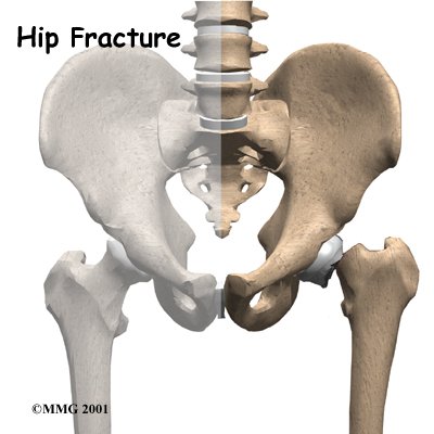 Hip Fractures