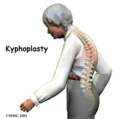 Kyphoplasty