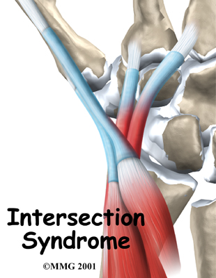 Intersection Syndrome