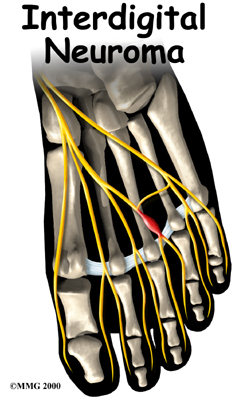 Interdigital Neuroma (Morton's Neuroma)