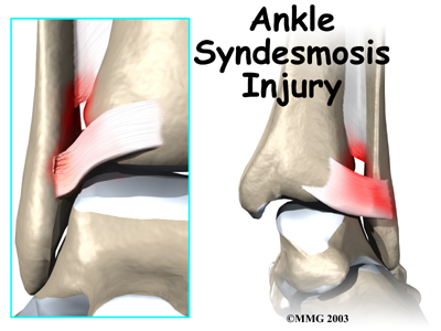 Ankle Syndesmosis Injuries