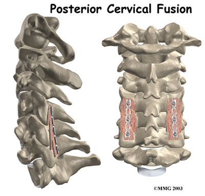 Physical Therapy In Westover For Posterior Cervical Fusion Surgery