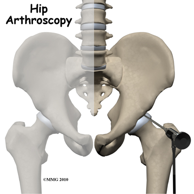 Hip Arthroscopy