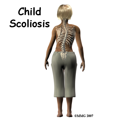 Scoliosis