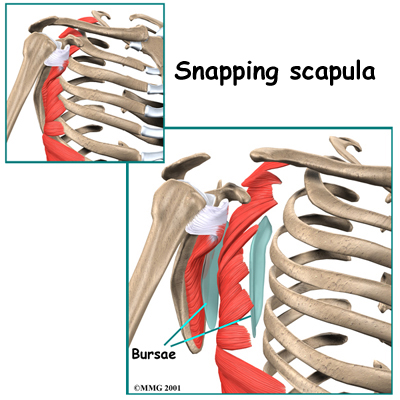 Snapping Scapula Syndrome