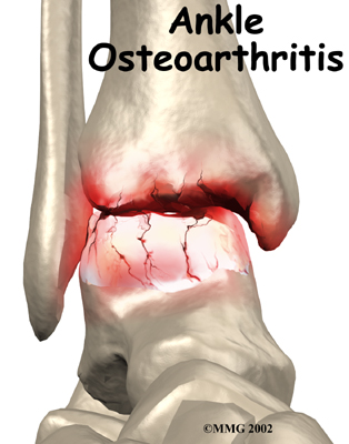 a calcaneus osteoarthritis)