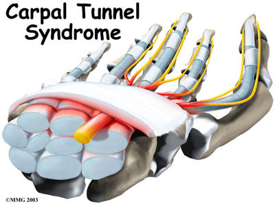 Carpal Tunnel Syndrome