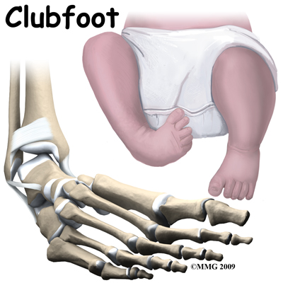 Physical Therapy In El Paso For Pediatric Issues Clubfoot