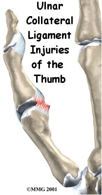 Ulnar Collateral Ligament Injuries of the Thumb