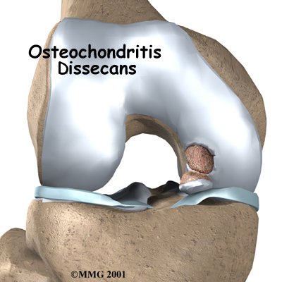 Osteochondritis Dissecans of the Knee