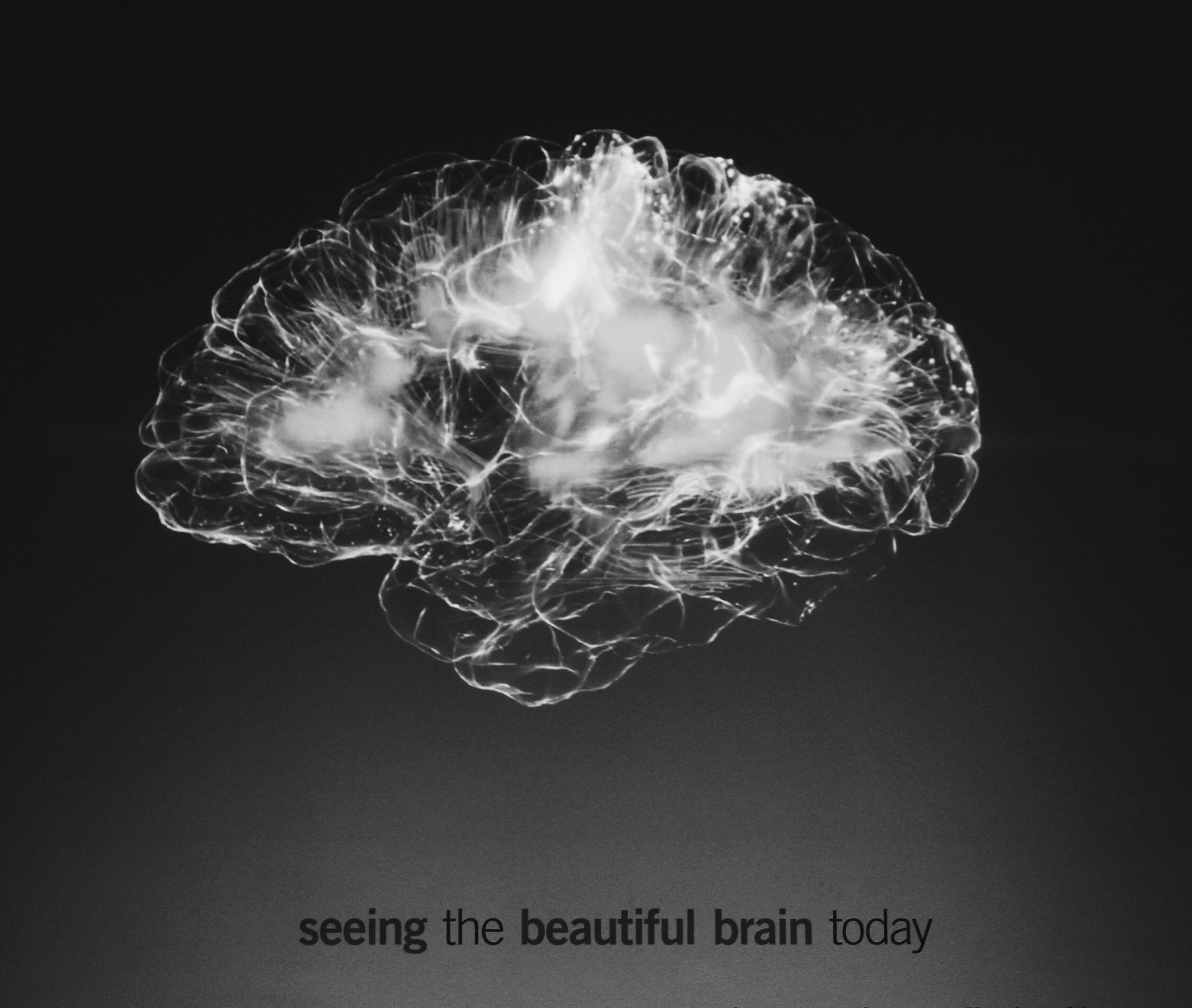 Alzheimer's and the beautiful brain, what physical therapy can do for Alzheimer's patients.