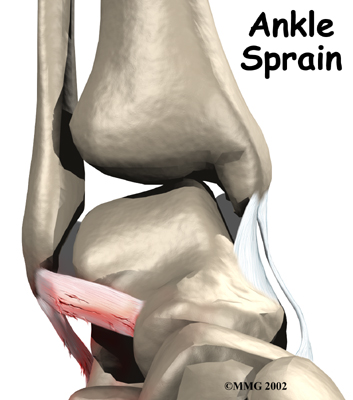 Ankle Sprain and Instability