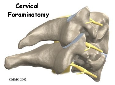 Cervical Foraminotomy