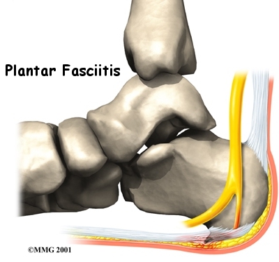 Plantar Fasciitis (Heel Pain)