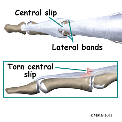 Physical Therapy in Pine Bluffs for Boutonniere Deformity of Finger