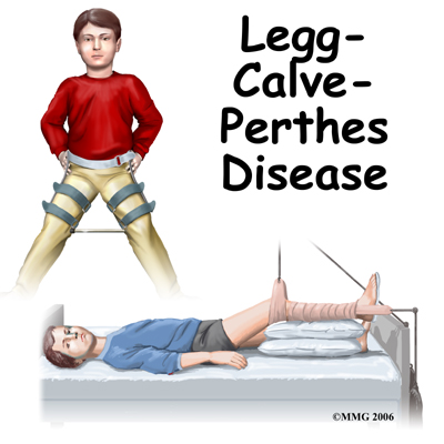 Perthes Disease