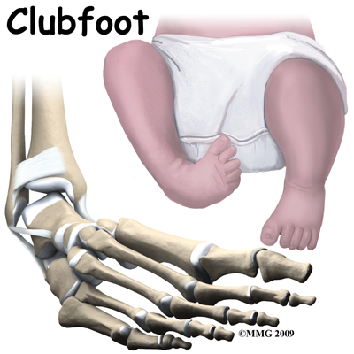 Physical Therapy In Plymouth For Pediatric Issues Clubfoot