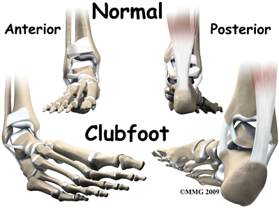 Physical Therapy In Plymouth For Pediatric Issues Clubfoot Physical Therapy In Plymouth For Pediatric Issues Clubfoot