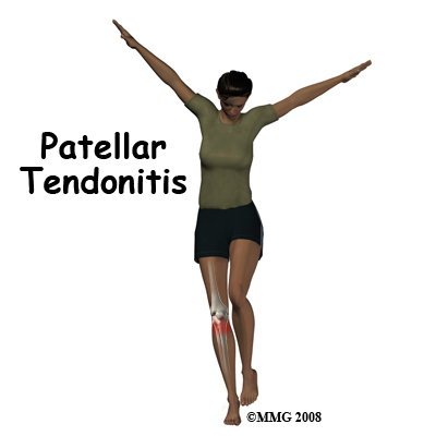 Patellar Tendonitis