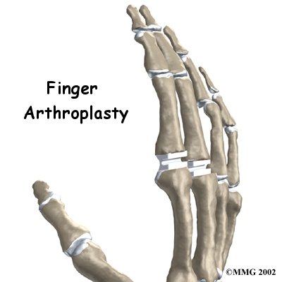 Artificial Joint Replacement of the Finger - Fyzical Provo's Guide