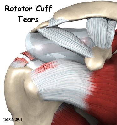 Rotator Cuff Tears