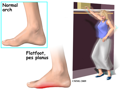 flat foot and ankle pain