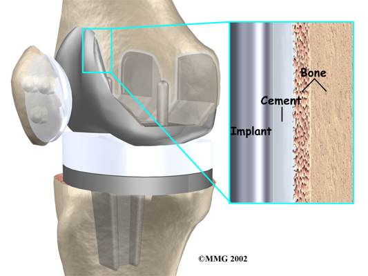 Physical Therapy in Raleigh for Knee Artificial Joint Replacement