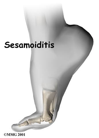 Sesamoid Problems