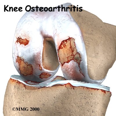 Osteoarthritis of the Knee