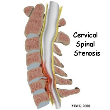 Cervical Spinal Stenosis