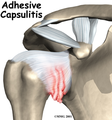 Adhesive Capsulitis Patient Guide