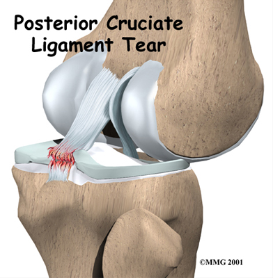 Posterior Cruciate Ligament Injuries