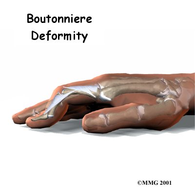 Boutonniere Deformity of the Finger