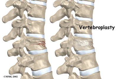 Vertebroplasty